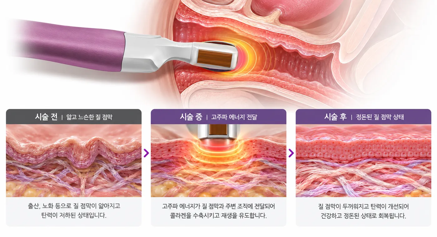 고주파 에너지가 질 점막에 전달되는 과정을 시술 전, 시술 중, 시술 후 세 단계로 보여주는 그림