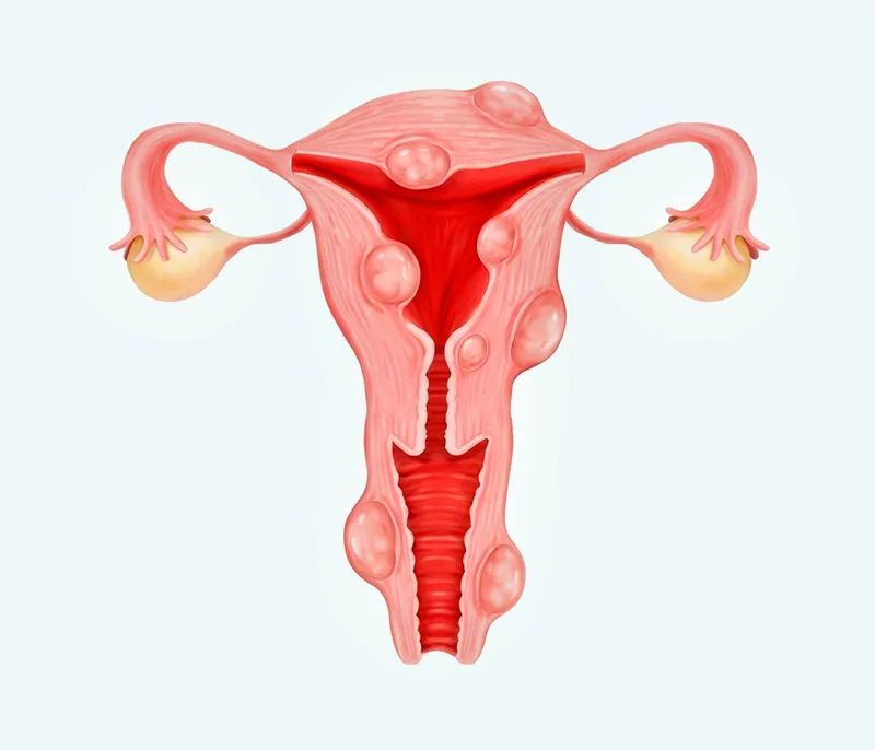 자궁근종의 위치와 크기에 따라 치료 방법이 달라지는 자궁 구조