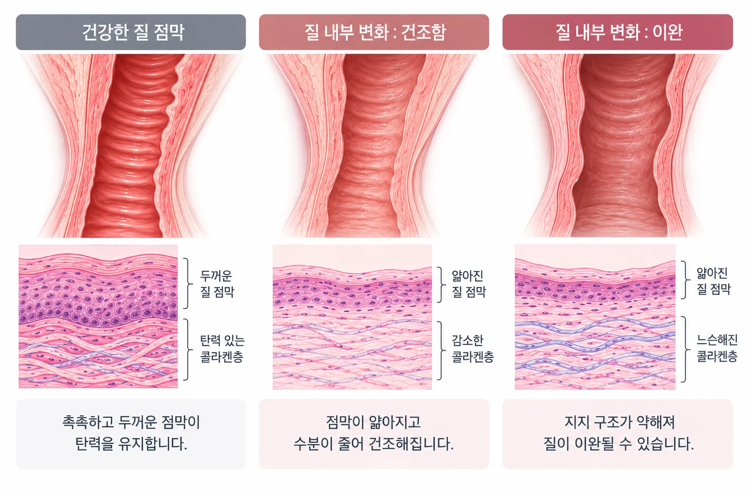 건강한 질 점막과 질 내부 변화(건조함·이완) 상태 비교 그림