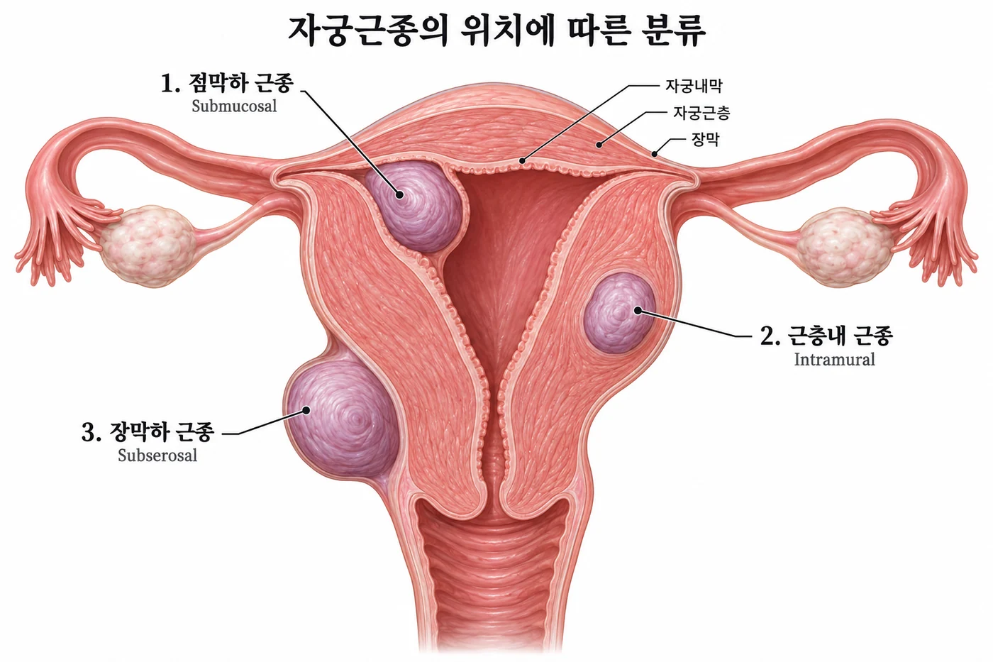 자궁근종의 위치에 따른 분류를 보여주는 그림: 점막하 근종, 근층내 근종, 장막하 근종과 자궁내막·자궁근층·장막 구조