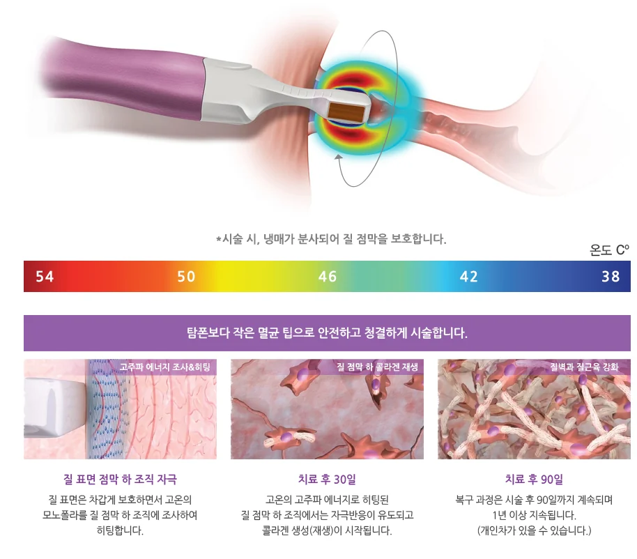 고주파 시술 기구가 질 점막에 닿는 모습과 치료 후 30일·90일 점막 하 조직 변화를 보여주는 그림