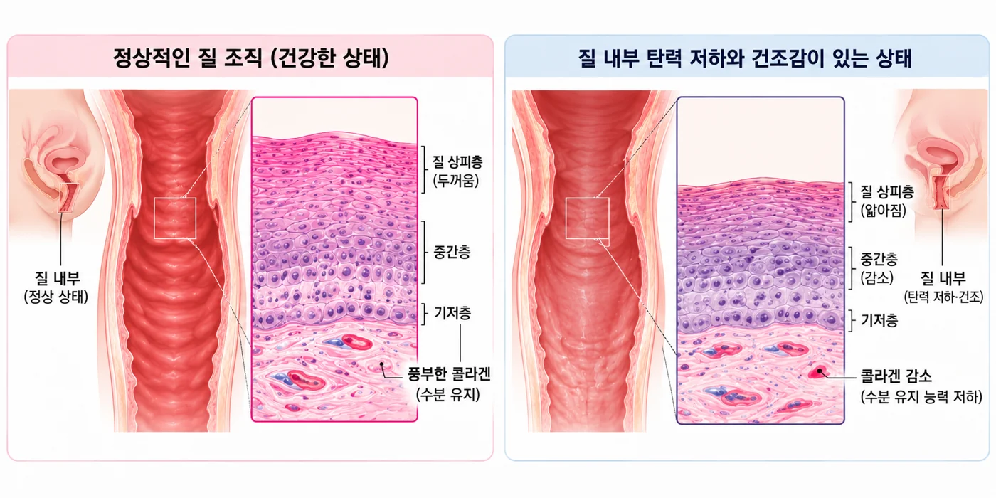 정상적인 질 조직과 탄력 저하 및 건조감이 있는 상태의 질 조직을 좌우로 비교한 그림