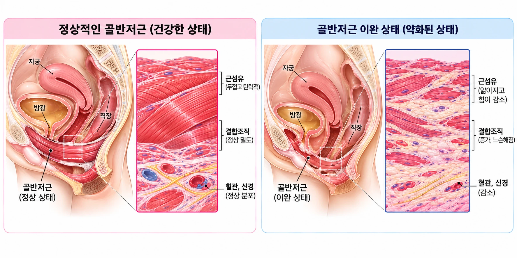 정상 골반저근과 약화된 골반저근의 위치와 조직 변화를 비교한 그림