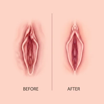 음핵포피 성형 그림